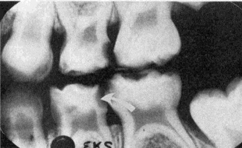 Perda de espaço Cáries interproximais, restaurações inadequadas, anquilose, perda precoce de dentes decíduos (cárie, traumas, processos anormais de reabsorção, processos patológicos figuras 6,7,8 e