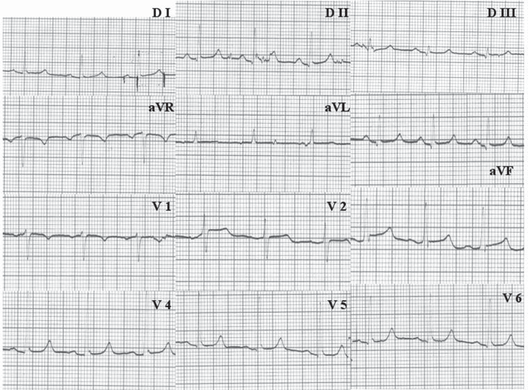 265 Figura 2 Eletrocardiograma de 12 derivações da paciente estudada, realizado na admissão mostrando ritmo sinusal, com bloqueio de ramo direito de 1 grau, sem alterações isquêmicas estratificação
