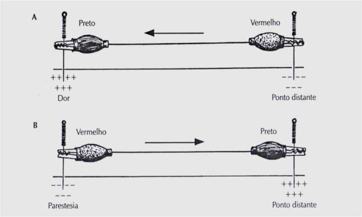 Conduz a corrente em um único sentido. Instituto Quallitas Fio de Manaka - Utilização 1. Inserir uma agulha de acupuntura no trigger point e outra em um acuponto distante ao local da lesão; 2.