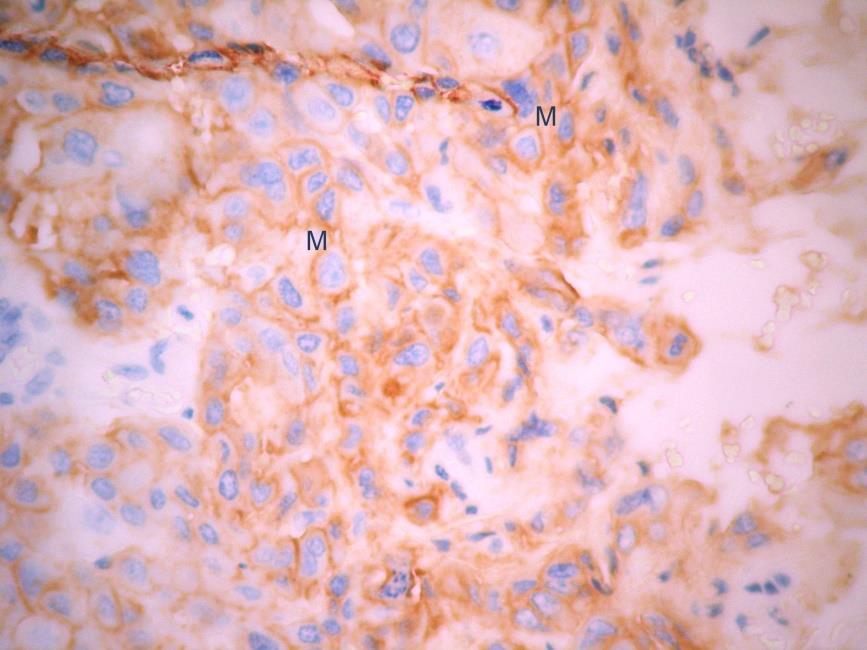 31 Figura 5. Imunohistoquímica do EGFR (receptor do fator de cresciment epidérmico) com marcação positiva.