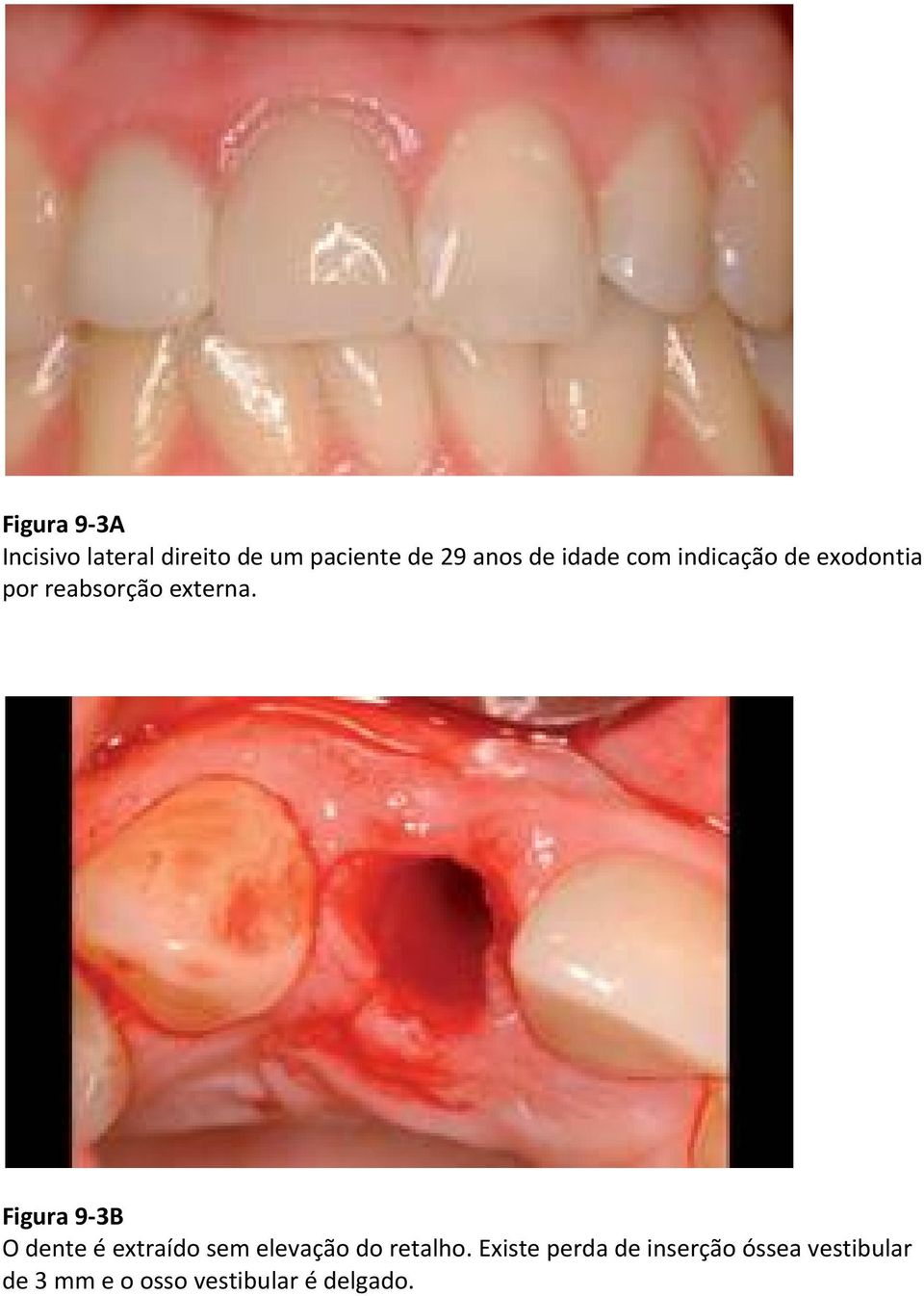 Figura 9 3B O dente é extraído sem elevação do retalho.