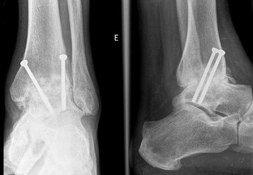 Figura 8. Artropatia do tornozelo em doente de 32 anos No Rx de face são claramente visíveis os geodes. Rx de controle, 3 meses pós artrodese.