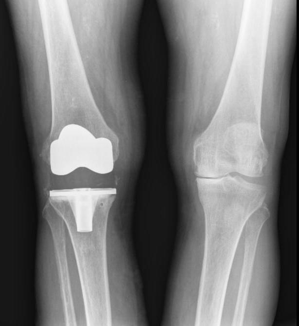 ARTRODESE Em doentes com artropatia avançada do tornozelo, a artrodese é o tratamento indicado.