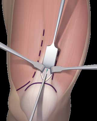 INCISÃO E DISSECÇÃO Antes de fazer a incisão, poder-se-á injetar um anestésico local na área, se desejado. 2 Faça uma incisão vertical de cerca de 1 a 2 cm em direção lateral ao ápice da patela.