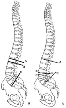 As medidas das angulações das curvaturas lombares, corpos vertebrais e discos intervertebrais foram realizadas manualmente, diretamente sobre as radiografias em perfil, utilizando-se como referência