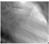 Após a tromboaspiração, não se observa lesão residual no nível do terço proximal da ADA, com uma leve opacidade no mencionado nível.