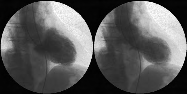 LUÍS ROCHA LOPES, et al Rev Port Cardiol 2008; 27: 495-502 provisório. O ecocardiograma transtorácico mostrava acinésia apical e hipocinésia da parede anterior e do septo anterior.