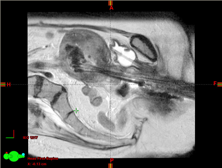 Braquiterapia guiada por imagem (IGBT) MRI (T2-W) com aplicadores in situ Orgãos de risco delineados com o aplicadores CT não é