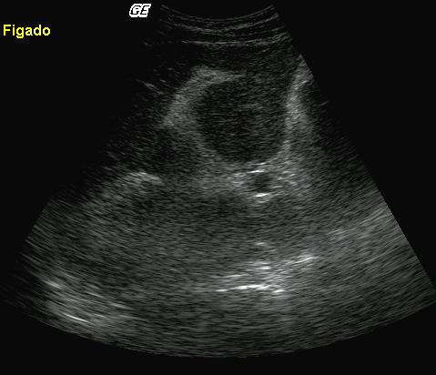 Fig. 2B Fig. 2B Fig. 2: Classificação da fibrose periportal: central, envolvendo apenas o tronco da veia porta (A); na bifurcação da veia porta (B) e periférica, acometendo os ramos portais periféricos (C).