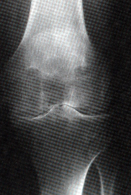 10. Imageamento Diagnóstico Ao examinar uma radiografia, o examinador deve observar: Tamanho e forma global do osso; Tamanho e forma local do osso; Espessura do córtex; Padrão trabecular do osso;