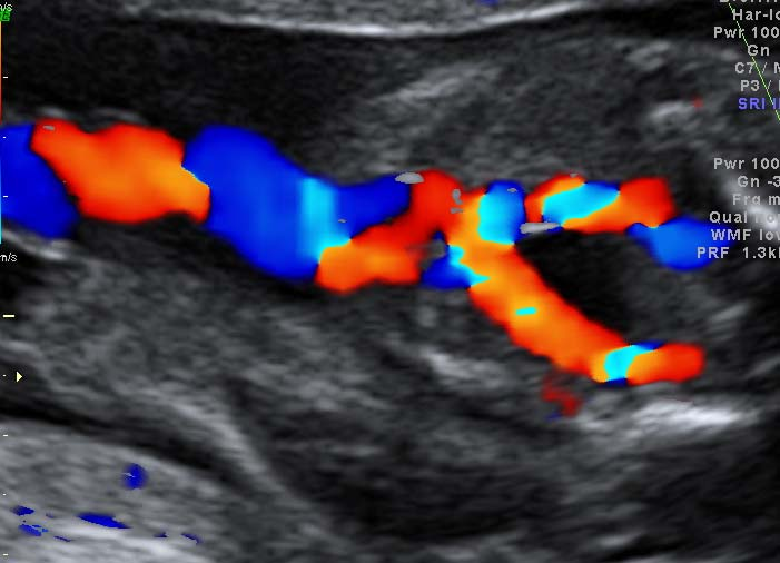REVISÃO DA LITERATURA 25 Bexiga FONTE: HCFMUSP Figura 7 - Corte transversal da pelve fetal, no segundo trimestre da gestação, no nível da bexiga