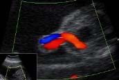 26 REVISÃO DA LITERATURA Bexiga FONTE: HCFMUSP Figura 8 - Corte transversal da pelve fetal, no segundo trimestre da gestação, no nível da bexiga urinária.