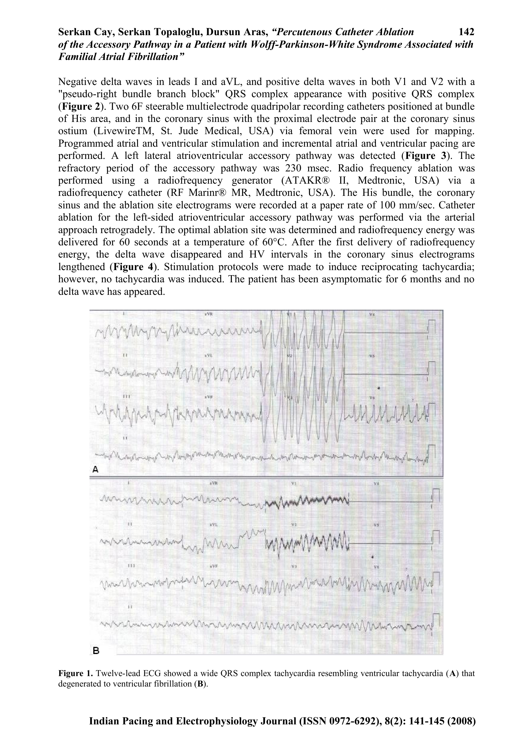 Figura 8: A) ECG de 12 derivações mostrando QRS alargados, irregulares, compatíveis com FA e pré-excitação que (B) degenera em FV. Fonte: CAY et al., 2008. 1.7.