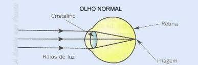 Um olho míope apresenta um foco antes da retina. Olho com miopia Um olho hipermetrope apresenta um foco depois da retina.