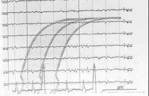 272 Arq Neuropsiquiatr 2002;60(2-A) Fig 2. EEG e tomografia do Caso 4: área hipodensa occipital esquerda. Fig 3. EEG e tomografia do Caso 6: atrofia occipital esquerda. mos occipitais (EPBI-O) 13.