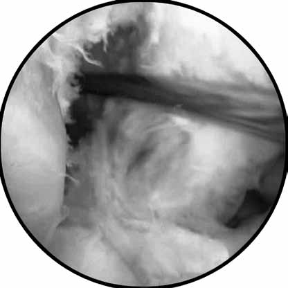 RECONSTRUÇÃO DO LCP COM ENXERTO AUTÓLOGO EM DUPLO TÚNEL FEMORAL 61 A B Lesões articulares associadas Nesta série, durante a artroscopia, lesões condrais foram encontradas em seis joelhos: três eram