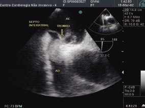 Figura 5: Corte dos átrios realizado a 133º em ecocardiograma transesofágico demonstrando átrio direito (AD) totalmente opacificado por contraste salino e passagem de pequena quantidade de contraste