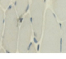 Resultados 55 Figura 7: Biopsia muscular de pacientee com diferlinopatia mostrando padrão distrófico leve pela técnica HE (A) e ausência de marcação ao redor das fibras na imunoistoquímica (C),