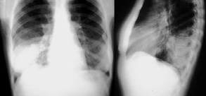Caso clínico 3 Etiologia das pneumonias Paciente sexo masculino, 34 anos, após gripe forte, apresenta febre, calafrios, dor torácica, tosse produtiva e dispnéia.