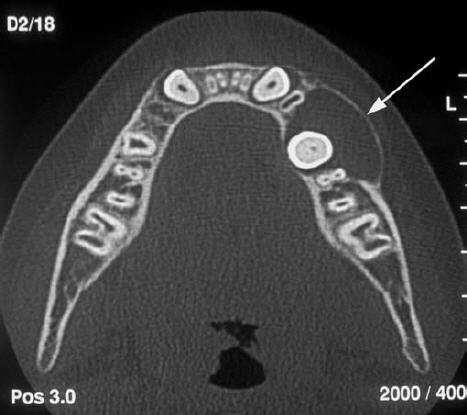 Quisto dentígero Quisto folicular Segundo tipo mais comum de lesão cística dos maxilares Localizado à volta da coroa de um dente incluso Ligado à junção esmalte-cimento Joaquim Agostinho - Unidade