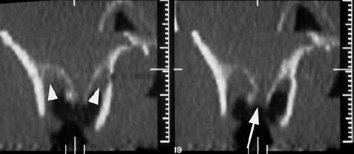 Fístula sinusal Dentascan : localiza o defeito ósseo planeamento