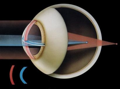 62 Deeitos da visão Astigmatismo: a superície da córnea não é esérica, é mais curva numa direcção do que noutra (corrige-se com uma lente assimétrica) Exemplo O ponto próximo de uma pessoa está a 75