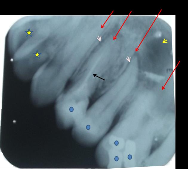 Figura 1 Imagem de radiografia periapical da região da maxila esquerda do paciente 01. A seta em vermelho indica a numeração dos dentes.