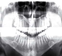 A B C FIGURAS 1A, B e C: Dente canino superior direito impactado em radiografia panorâmica (A); radiografia oclusal (B) e radiografias periapicais segundo a técnica de Clark (C).