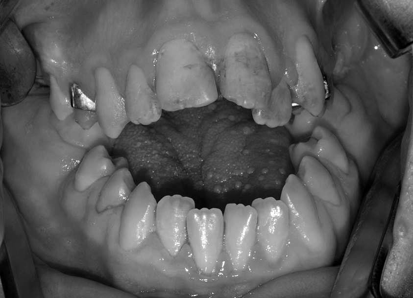 adequadamente as fossas oclusais dos pré-molares e molares inferiores 1.