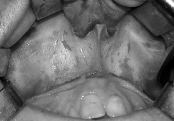 Figura 3 - No exame intrabucal, mordida cruzada posterior e anterior, Classe III e mordida aberta anterior Figura 4 Acesso da maxila, seguida da incisão e descolamento mucoperiosteal na região de