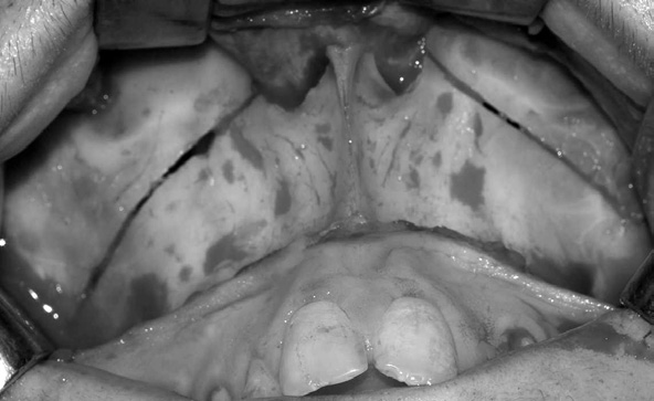 cinzel com guia e martelo Figura 7 - Disjunção pterigomaxilar bilateralmente com cinzel curvo e martelo Figura 8 - Osteotomia da sutura palatina mediana.