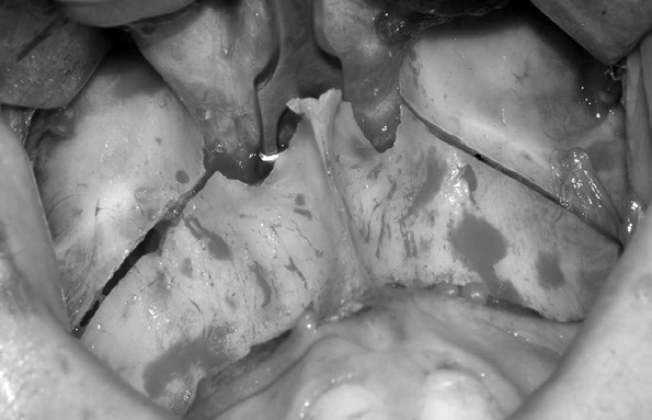 maxila, combinado com excesso horizontal mandibular (Figura 2). Já no exame intrabucal, notou-se mordida cruzada posterior e anterior, Classe III e mordida aberta anterior (Figura 3).