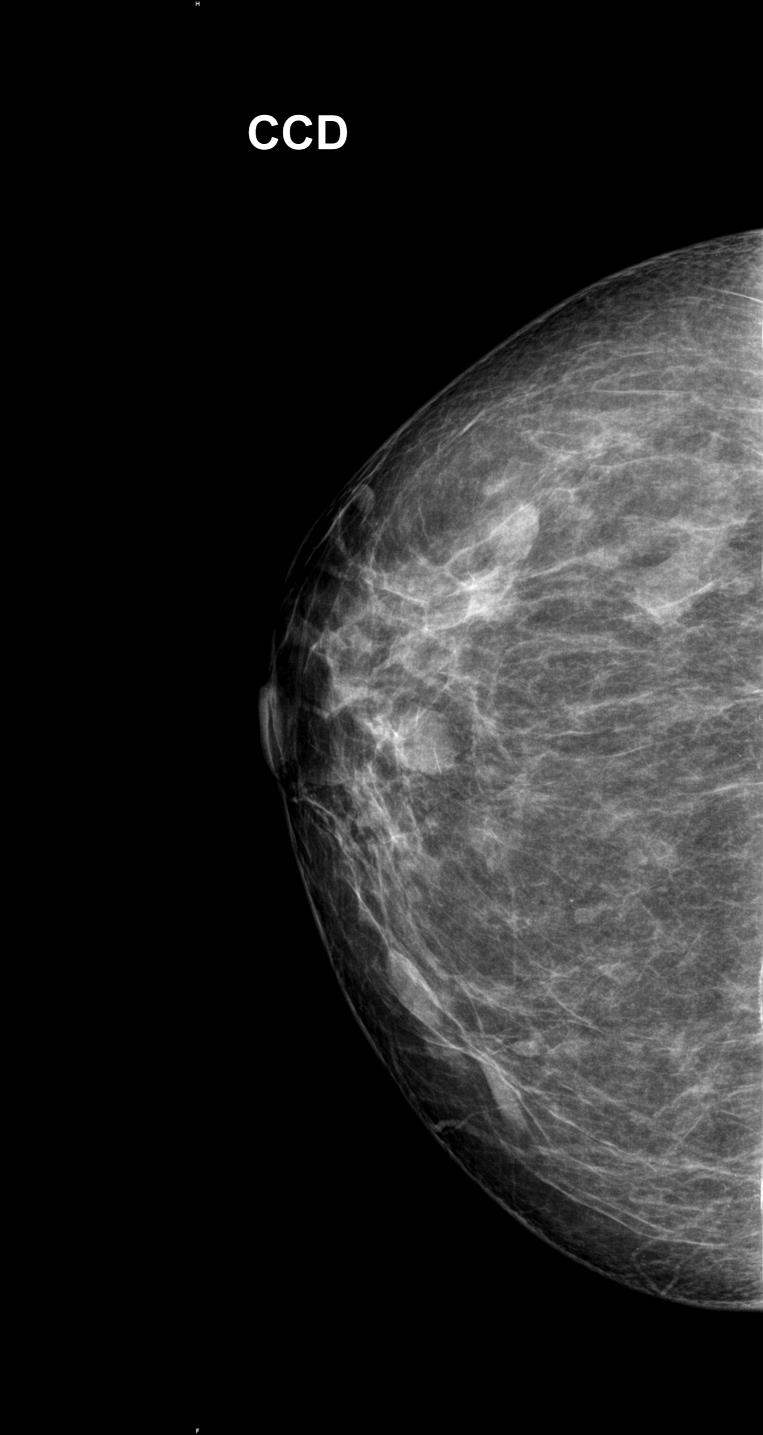 Mamografia de mamas com esessuras semelhantes (60 mm) e