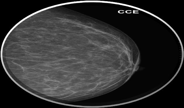 mamografia digital deve