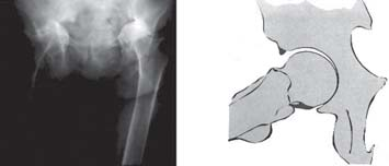 81 PROATO SEMCAD Figura 8 Osteoartrose concêntrica Osteoartrose interna Na osteoartrose interna, existe obliqüidade na superfície de carga e isso provoca uma diminuição da cartilagem e redução do