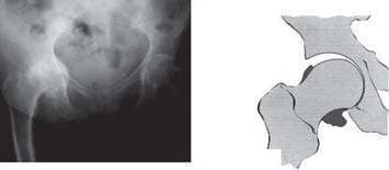 82 OSTEOARTROSE DO QUADRIL Osteoartrose inferomedial LEMBRAR A osteoartrose inferomedial é uma forma rara de osteoartrose e se caracteriza pelo desaparecimento da