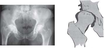 Osteoartrose normotrófica Na osteoartrose normotrófica, existe a formação de osteófitos no acetábulo e sobre a cabeça femoral (normalmente deformada) com área de