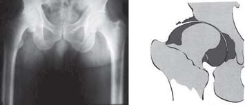 83 PROATO SEMCAD Figura 12 Osteoartrose normotrófica Osteoartrose hipertrófica Na osteoartrose hipertrófica, forma-se a megacabeça, que está deformada pelo grande