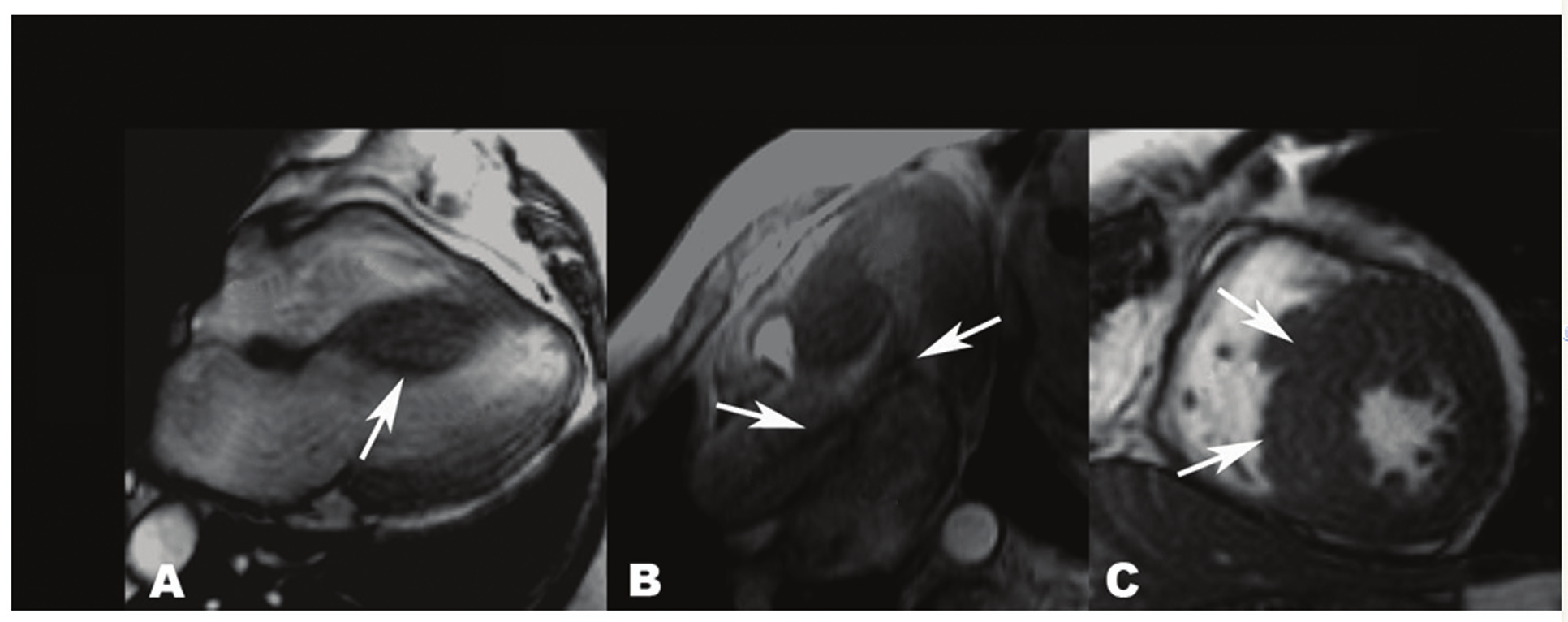 Ao Fig. 1 - Exemplo de paciente com padrão clássico de cardiomiopatia hipertrófica. O painel A mostra um corte longitudinal apical de quatro câmaras com hipertrofia septal assimétrica clássica (seta).
