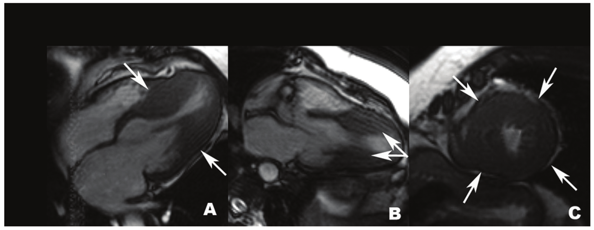 Fig. 3 - Exemplo de paciente com cardiomiopatia hipertrófica. Os painéis A e B mostram cortes longitudinais com hipertrofia isolada localizada no segmento médio do ventrículo esquerdo (setas).