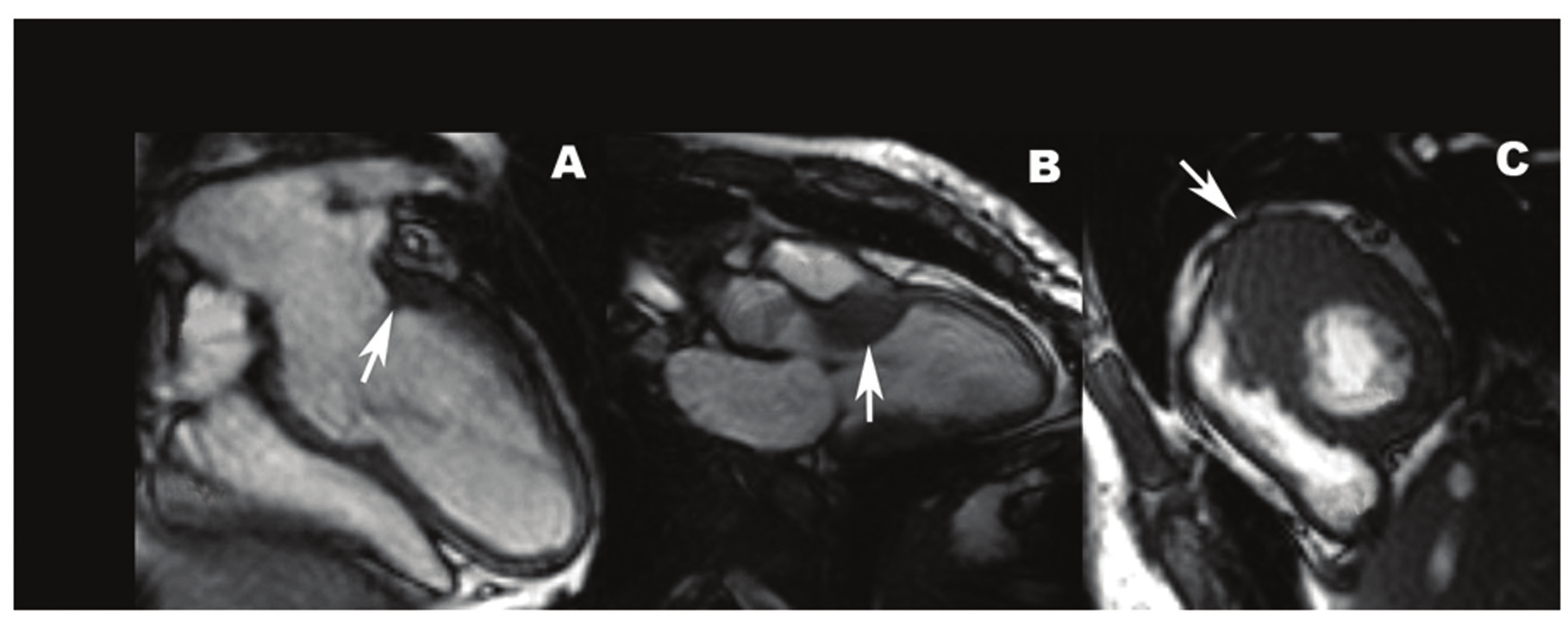 Ao - Aorta; - átrio esquerdo; - ventrículo esquerdo; VS - via de saída do ventrículo esquerdo; - átrio direito; - ventrículo direito. Ao Fig. 4 - Exemplo de paciente com cardiomiopatia hipertrófica.