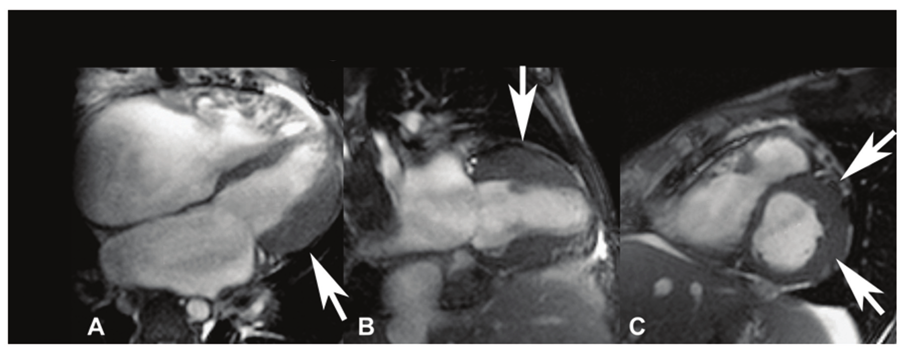 Fig. 5 - Exemplo de paciente com cardiomiopatia hipertrófica. Painel A: No corte longitudinal de quatro câmaras, observe a hipertrofia da parede lateral do ventrículo esquerdo (seta).