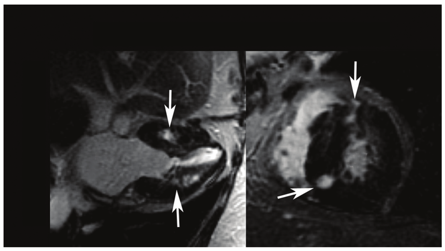 Painel C: no corte transversal, a hipertrofia ântero-lateral da parede do ventrículo esquerdo pode ser avaliada simultaneamente (seta).