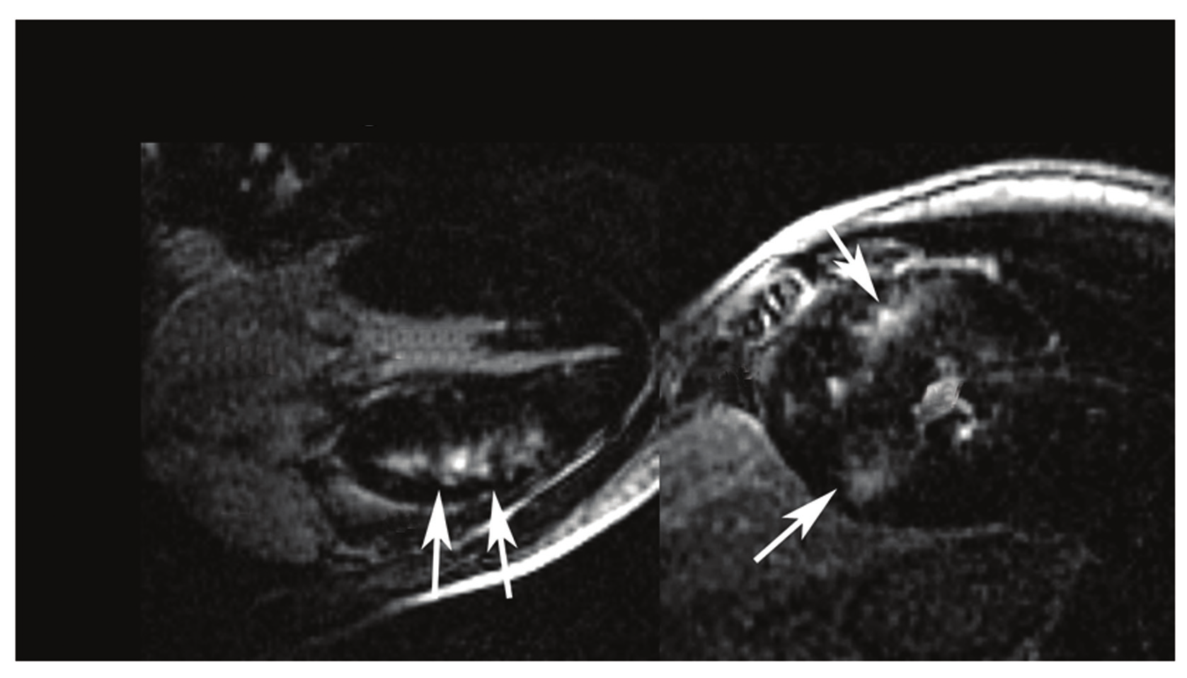 realce tardio Fig. 7 - Exemplo de paciente com cardiomiopatia hipertrófica. Corte longitudinal (esquerda) e transversal (direita) evidenciando realce tardio em múltiplos focos com padrão difuso.