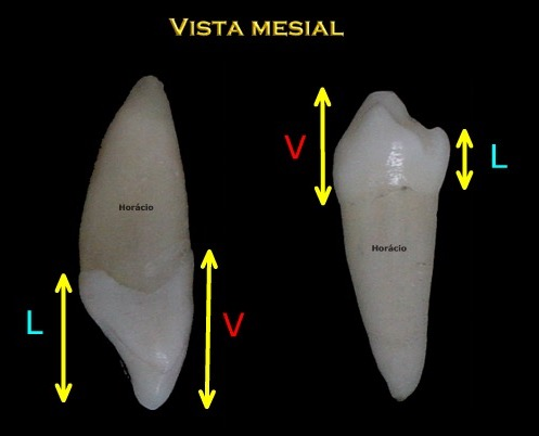 terços mesial, médio e distal -- senado vesqbulo-lingual: terços vesabular, médio e lingual As