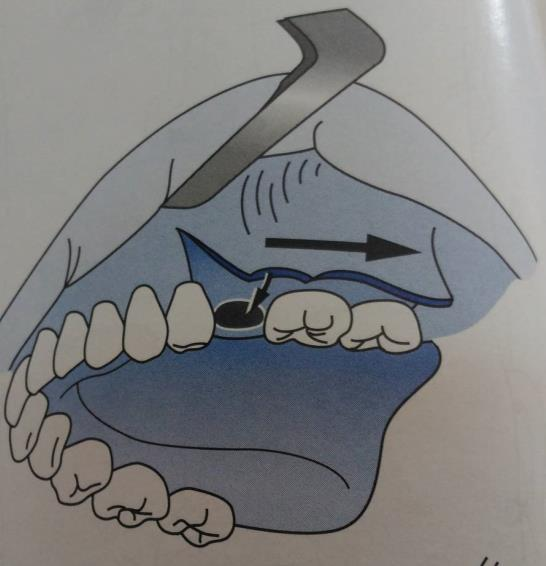 Figura 4: Esquema ilustrativo do retalho vestibular de Môczaír. Fonte: Peter s Principles of Oral and Maxillofacial Surgery, 2004 (adaptado) (sem autorização do autor) 3.