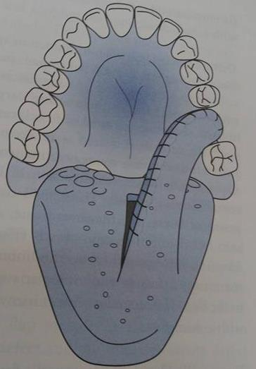 Figura 6: Esquema ilustrativo do retalho lingual do dorso da língua. Fonte: Peter s Principles of Oral and Maxillofacial Surgery, 2004 (adaptado) (sem autorização do autor) 3.4.2.5.