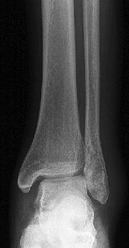 2. Lesões Traumáticas -as fracturas Aspectos radiográficos da fractura recente Traço hipertransparente
