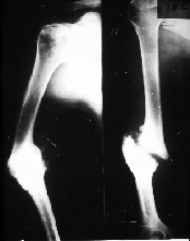 moles adjacente à fractura aumento da densidade (+ cálcio) reposição continuidade óssea