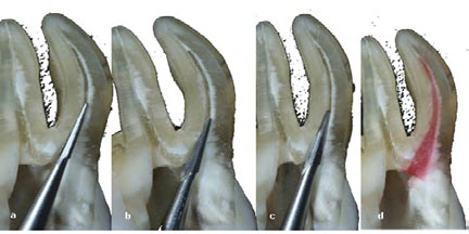 As brocas Largo diferenciam-se das brocas Gates-Glidden na extensão de suas lâminas de corte e na menor flexibilidade de sua haste.